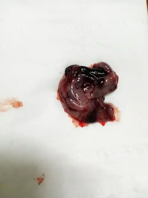 流产,三天后傍晚肚子闷闷的疼,排出一块脚趾头般大的组织,是胚胎组织