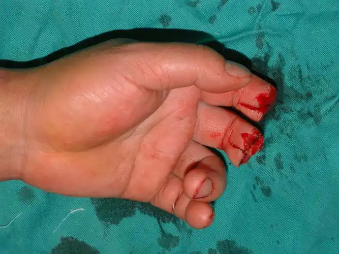 手指再造 - 好大夫在线