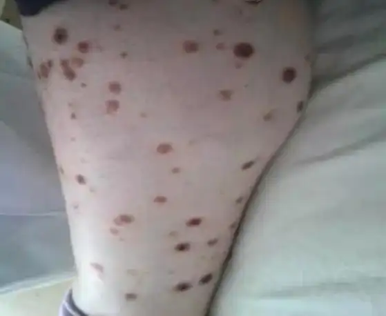 2型糖尿病伴获得性反应性穿通性胶原病一例