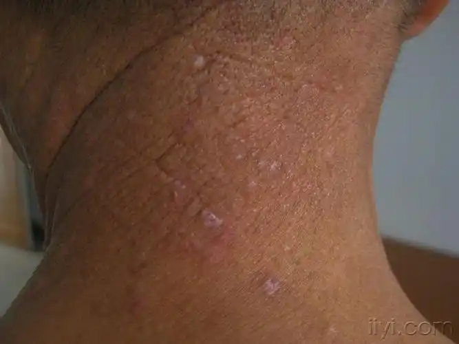 神经性皮炎皮肤淀粉样变