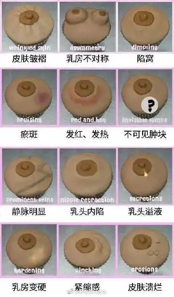 1,乳头溢液:可以是乳汁样的溢液,也可以水样溢液,还可能是血性溢液.