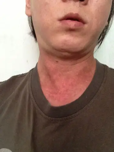 最佳答案 热心网友  2013-08-10   展开全部 皮肤过敏  追问 那怎么