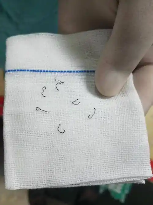 女子做痔疮手术留隐患10年8次手术取出30多枚钛钉法院判赔62万