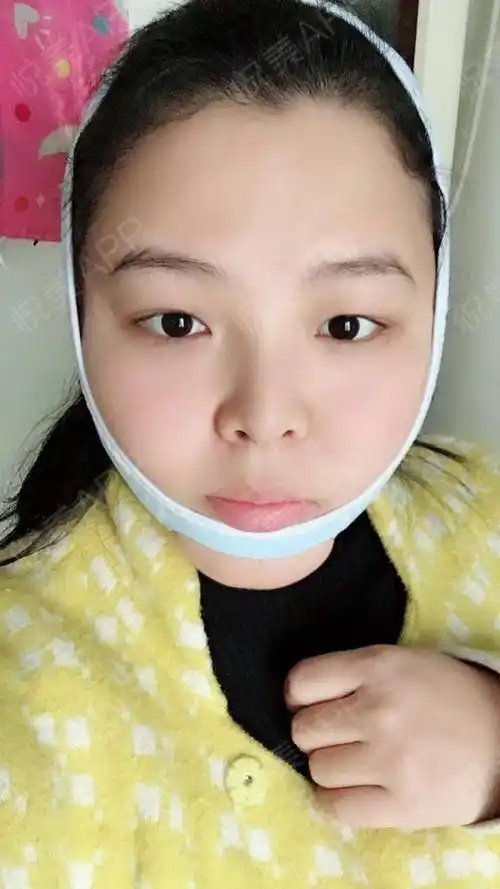 就放几张恢复期的照片吧做完面吸要带1-2周头套,因为.瘦脸_悦美整形