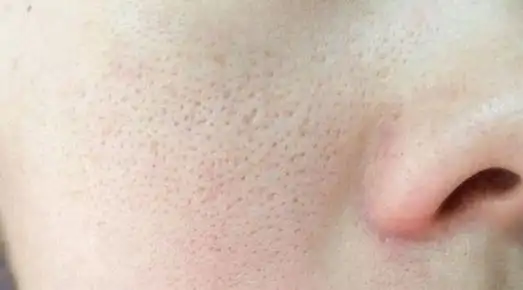 揭秘皮肤毛孔粗大的真相