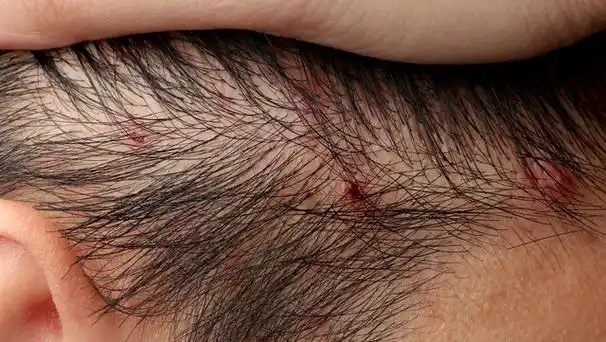 毛囊炎疙瘩怎么消除,剃阴囊毛囊炎疙瘩怎么消除(疖和毛囊炎有何不同)