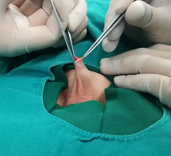 隐匿阴茎矫形术(f法)