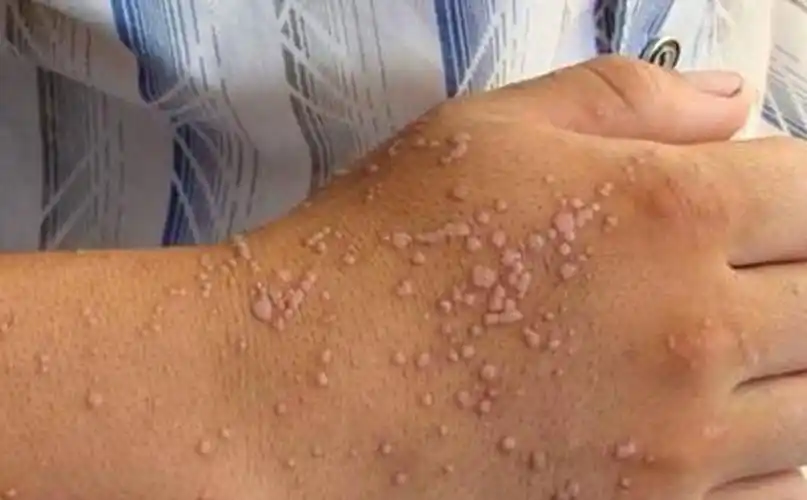 手背扁平疣初期图片
