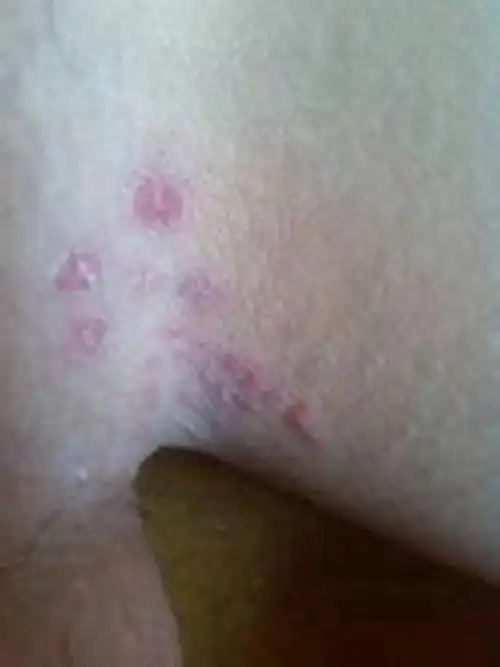 大腿外侧股癣 图片_有来医生