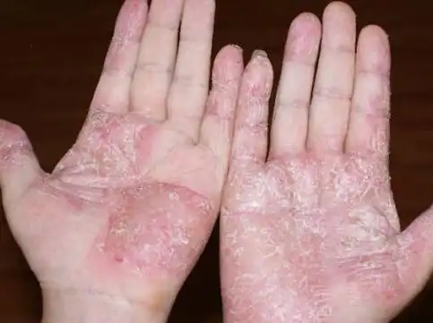 治疗鹅掌风秘方