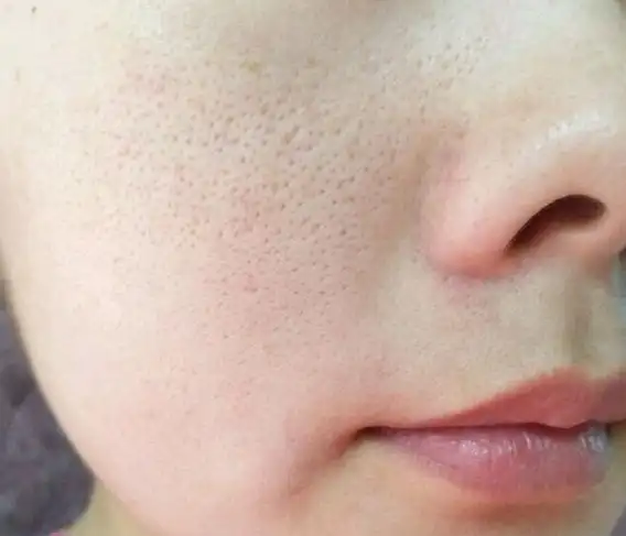 毛孔粗大也是分类型的,说说几种常见的 一,单纯性毛孔粗大