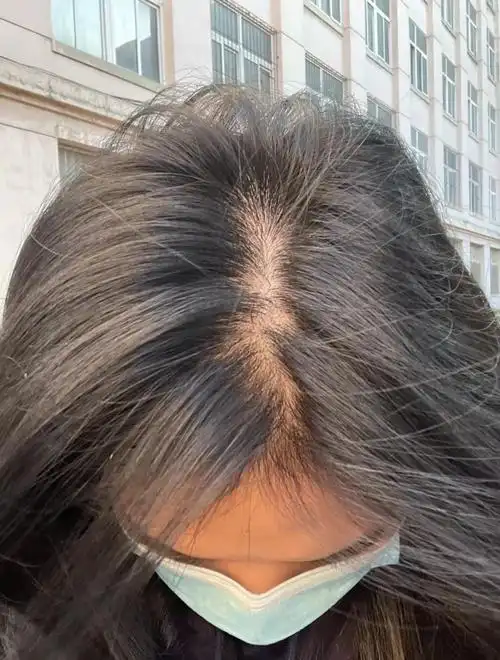 20多岁女孩子脱发严重是什么感受? - 知乎