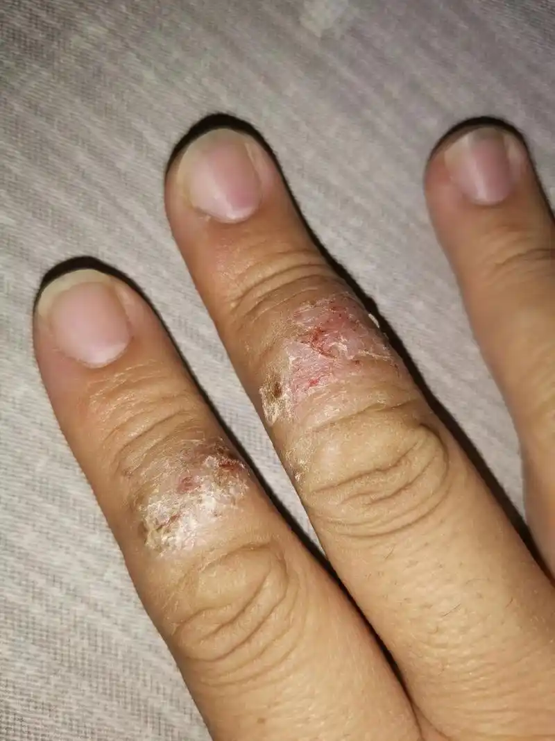 手指上皮肤脱皮反反复复,痒!求助各位皮肤科医 - 抖音