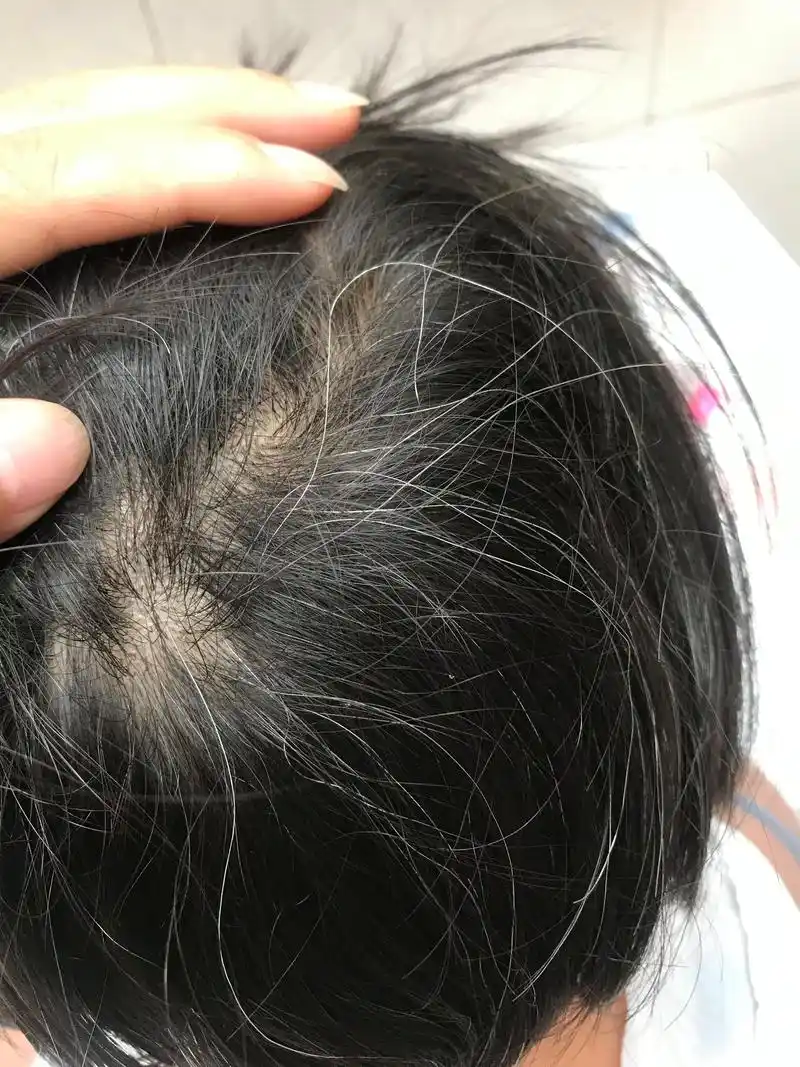 小孩子从两岁左右开始有白头发现在10岁越来越多也去