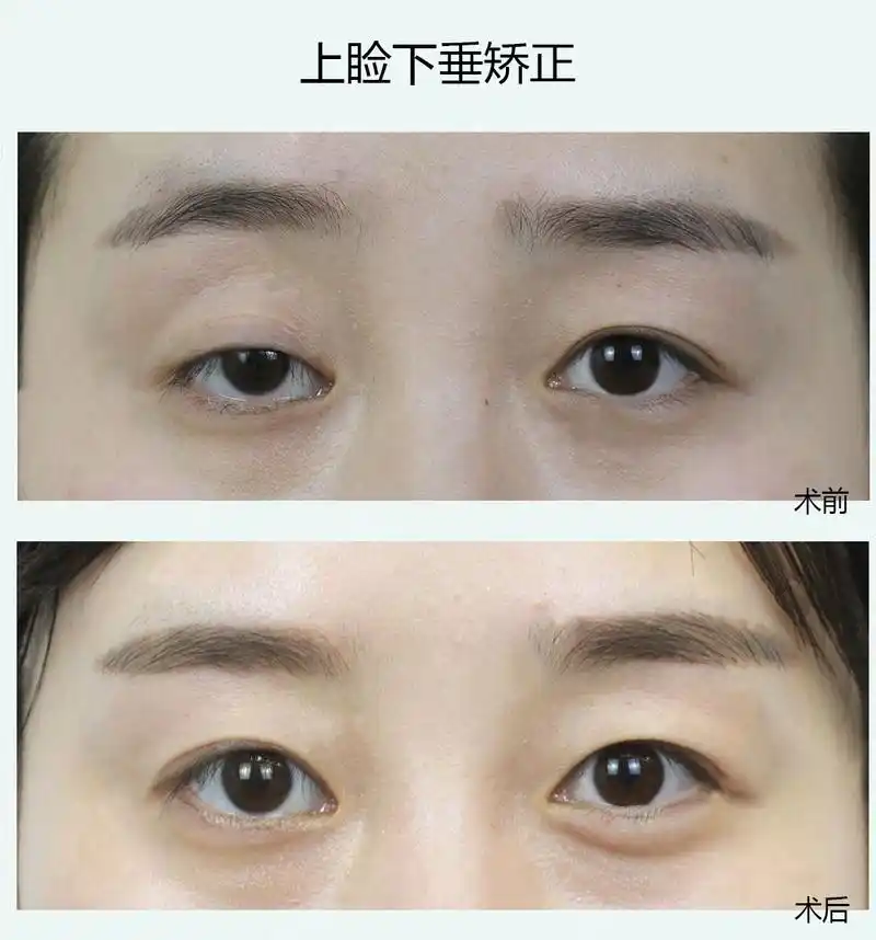 余文林:上睑下垂的原因 上睑下垂如何矫正_治疗