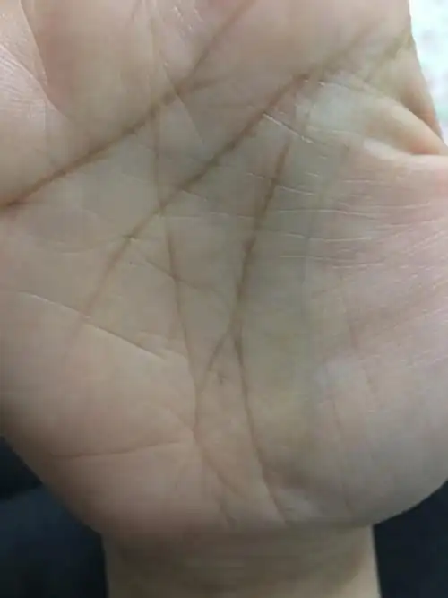 我这个手相,生命线上有岛纹是不是死定了……求大神