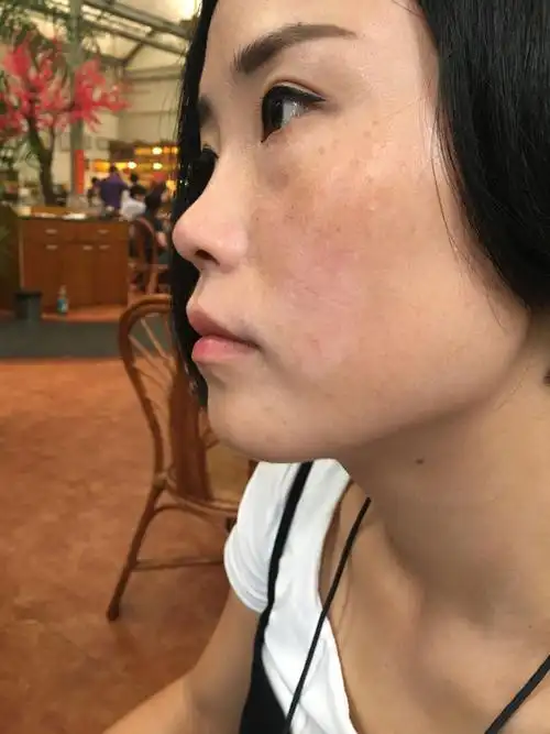 脸上刚出一块白色跟吃感冒药和海鲜有关系吗?