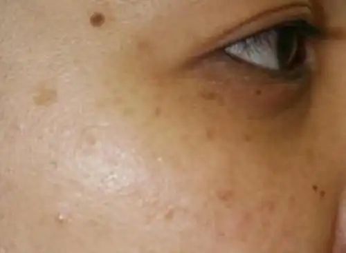 眼角长斑了怎么办