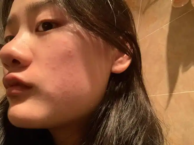 过敏性皮肤抗争的三年