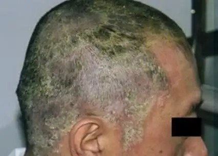 头癣症状图—— 还有其他症状么?咨询在线皮肤科主任