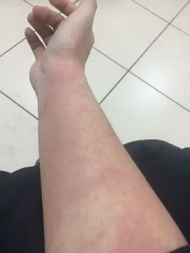 浑身上下起红点点 特别痒身体伴的发热 去医院查是过敏性皮炎 但是