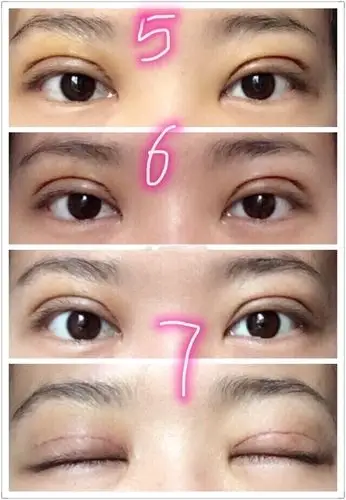 全切双眼皮去皮去脂前后对比图来了