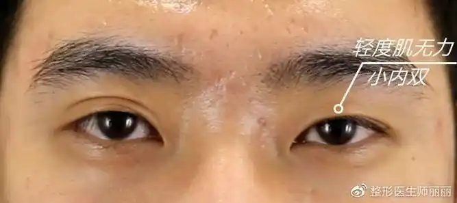 天生一单一双 皮肤松弛上睑肌无力 这种情况两侧眼睛要一起调整吗?