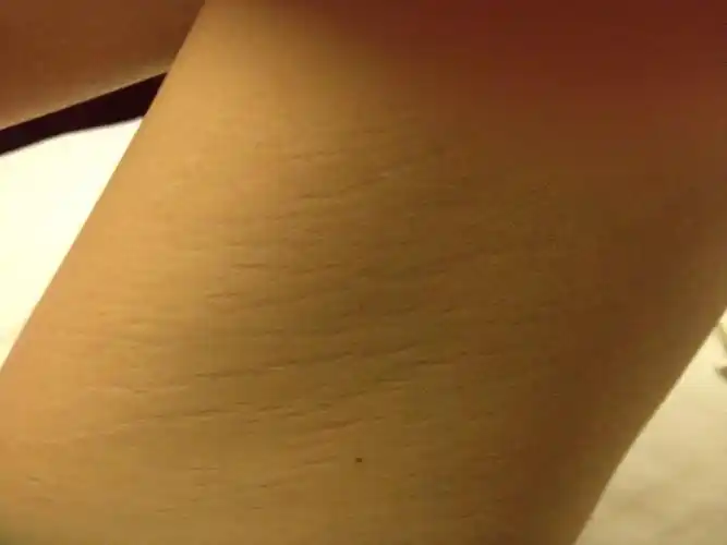 164高,最胖的时候132斤,现在108,大腿内侧很多像妊娠纹一样东西,是不