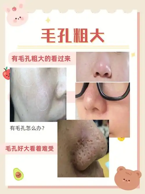 毛孔粗大