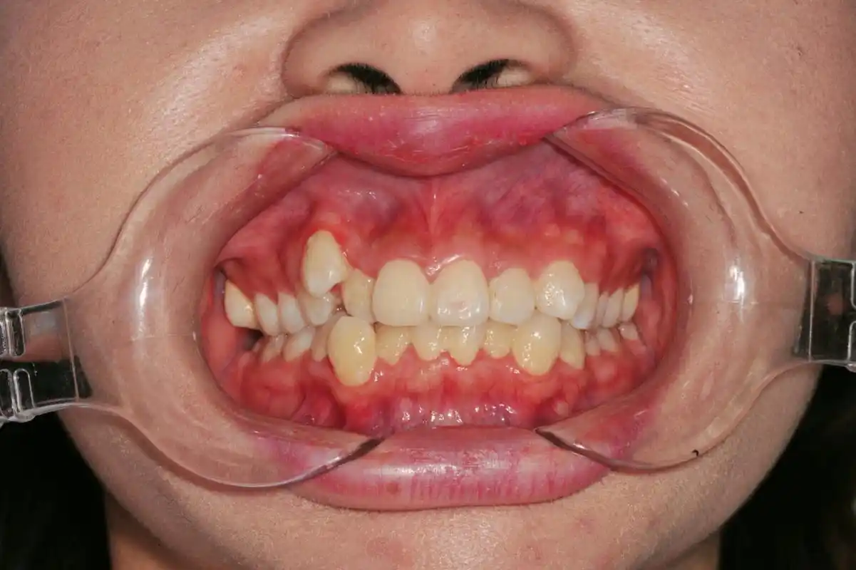 很多人都想把尖牙拔掉,觉得那样就整齐了,在临床上,常常会有人要求把