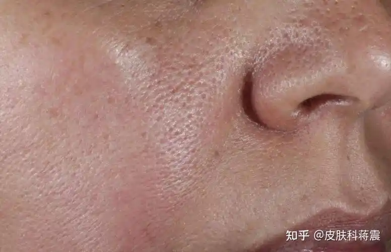 毛孔粗大有哪些类型该如何治疗