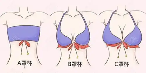 从隆胸效果图看,假体能做出c罩杯_最热整形行业新闻话题 - 美佳网
