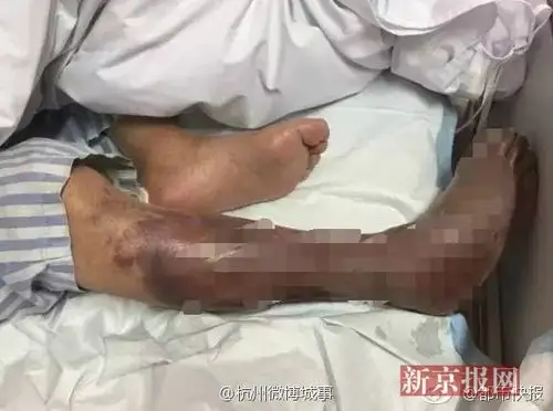 右小腿严重感染,必须截肢才能保命