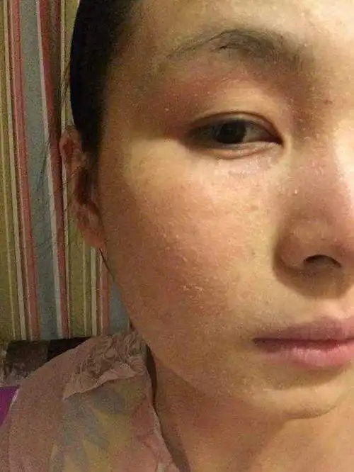 女生脸上脱皮用什么水乳比较好? - 知乎