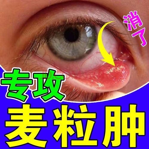 麦粒肿眼贴霰粒肿睑板腺堵塞视物模糊沙眼灼烧感眼痛痒异物感眼睑炎