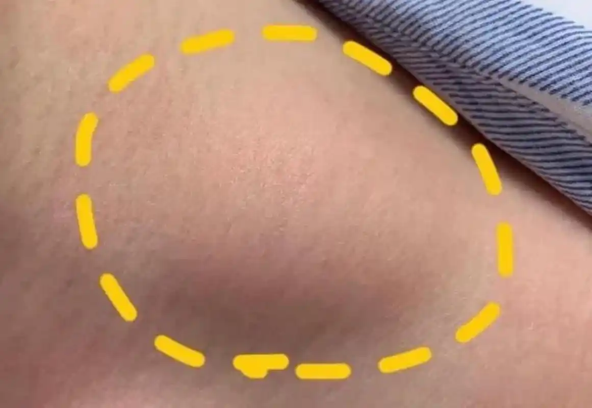 现在好多人身上都会长一种肉疙瘩,这种肉疙瘩,它不是长在身体里面