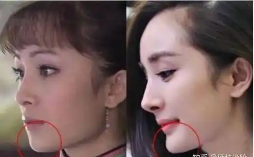 杨幂的下巴在做过下颌骨磨骨手术以后就显得不够长而之后下巴又变得