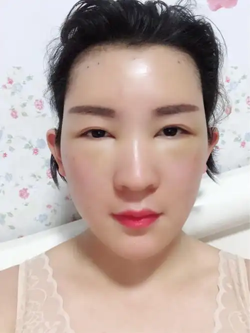 面部脂肪填充变化