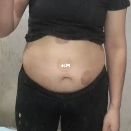 腰腹环吸术前术后对比,还在恢复期,今天第三天_舟山_腰腹_减肥_减肥