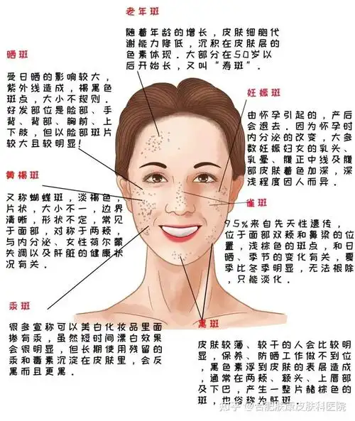 斑部分面部色斑黄褐斑,表皮与真皮均可累及的一种色斑.