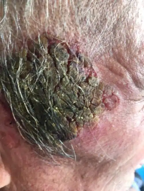 男,68,全身多发性红斑结痂.