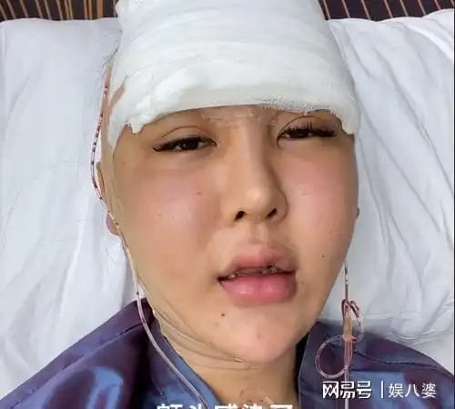 桃花宝宝多次整容留后遗症脸形像胖头鱼长相不如从前好看