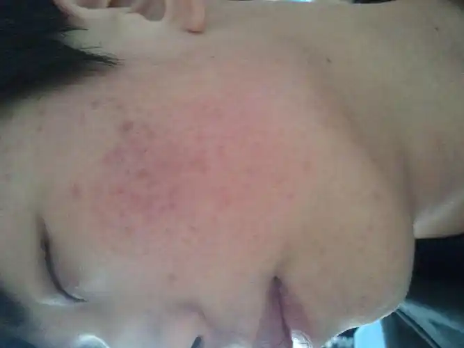 您好我是男生18岁 我是油性敏感皮肤 一年前脸一直红还有痘印类似的