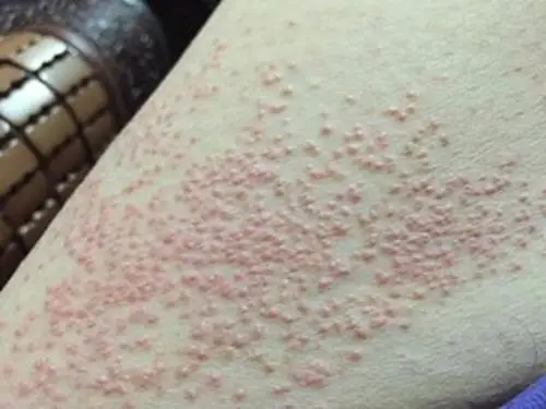 孕妇疥疮初期腹部皮肤症状图片