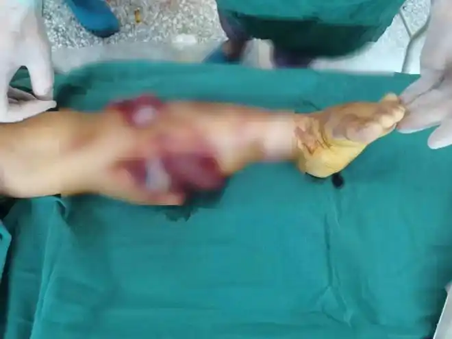 遭重型工程车履带碾压瑞金10岁女孩的断肢保住了