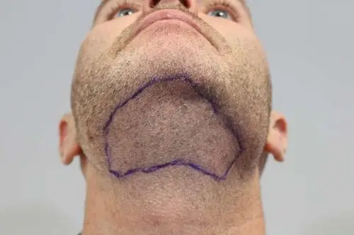 头发稀少能植发吗?体毛种植了解一下