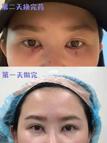 眼角回包第二天