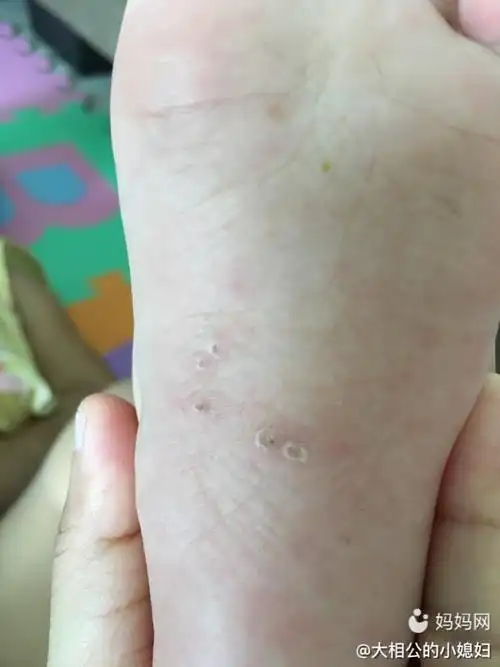 大家帮我看看宝宝脚底怎么了有知道的吗