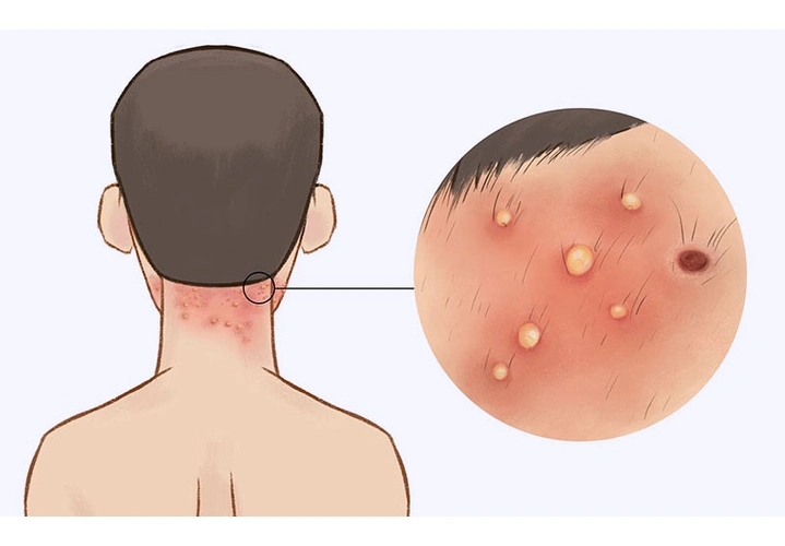 头皮毛囊炎可以自己挤吗多久才能治好
