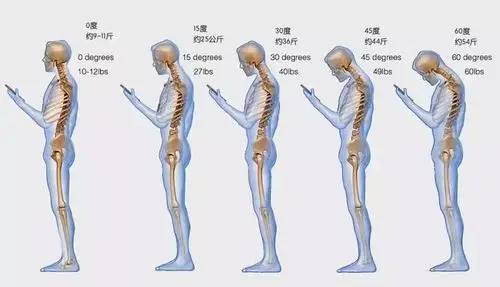 不正确的姿势也容易导致富贵包,如长期头前倾,低头看手机,圆肩驼背